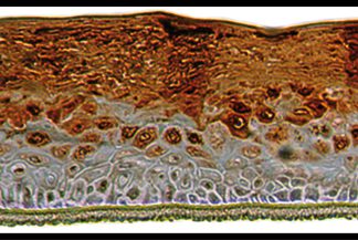 Psoriasis like epidermis